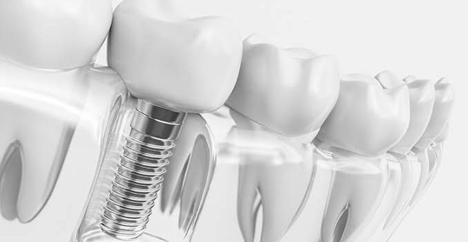 dental implant